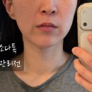 케어톡 | 부산 윤곽관리 소다톡 이중턱과 입술 볼륨 케어 후기