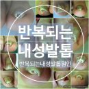 파고드는 내성발톱, 뿌리까지 해결하자 강남 풋스올 GNCT커브드네일 케어