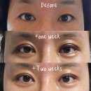 프리티멍 | 쌍커풀매몰+눈매교정 대만족 성형후기 (2주경과)