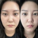 메디테라피 텐션 업 마스크 내돈내산 솔직후기 (장단점, 사진 전후 비교)