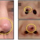 코염증 원인 코에 염증 생기는 이유 통증 대처법 이미지