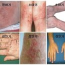 아토피성 피부염 (Atopic Dermatitis) 이미지