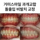 위스마일치과교정과치과의원 | 위 치아가 내려와 생긴 거미스마일과 입술 돌출, 앞니 스크류 비발치 교정으로 개선한 과개교합 사례...