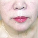 31140-8-60-7 | 60대 엄마 리프팅 시술 후기｜효도선물로 해드렸어요 🙏✨｜ 통증·비용·효과 솔직후기
