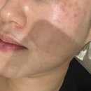 1회 사진기록전 | 서면 피부과 블랙색소레이저 1회 일주일 후기(+사진 전/후)