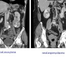 benign renal neoplasms 이미지