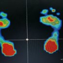 골반변형과 오십견증상이 있는 30대중반 여성의 발분석 이미지