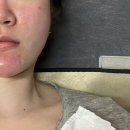 이마트24 부천상동연우점 | 상동 여드름관리 :: 압출부터 하이푸 탄력까지 효과 제대로 본 뷰티포톤피아 후기