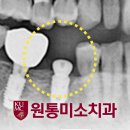 원통미소치과의원 네이버블로그