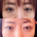 멀티솔루션 | 기미패치 추천, 마이크로니들 아르페 다크스팟 솔루션 멀티패치로 잡티 미백 관리 후기