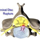 Canine Cervical Disc Disease 이미지