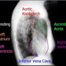 chest AP /LAT. 영상구조 이미지