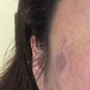 서초중앙로 42 (2) | 장덕피부성형센터 서초점 : 리팟레이저 진짜 인스타처럼 한번에 된다고 ? 내돈 내산 첫째날 후기