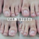 J4070 | 의정부·동두천 발톱무좀 내성발톱 무좀 병원 찾다가 결국 정착한 곳