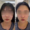 천안 불당동 피부과 텐쎄라 리프팅 솔직 후기