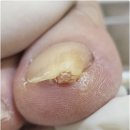 닥터아이티엔파주점 | 파주 금릉 발톱무좀 제대로 관리해주는 금손네일