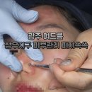 서구-01-64 | 광주 여드름 상무지구 피부관리 피지쏙쏙