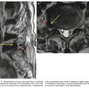 허리디스크 탈출의 extraforaminal zone(lateral recess) 유형탐구 이미지