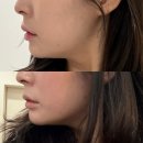 뉴리젠 | [대전] 얼굴형 관리 원탑은 끌리메에서 뉴작은얼굴 후기