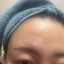 대구자연한의원 | 대구흉터치료 동성로한의원 이마패인흉터 새살침 받은 후기