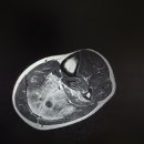 R/O vasculitis of unknown origin 이미지