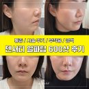 600 | 덴서티 알파팁 600샷 효과 2주 후기 : 통증, 시술 주기, 금액