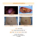 급성담낭염수술후기. 원장님이 초음파, CT사진 하나하나 집어주시면서 차근차근 설명해주셔서 믿음이 가 수술을 결정하게 되었습니다. 이미지