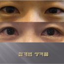 쌍수잘하는곳 긍정적인 결과를 위해서는