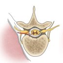 척수병증[myelopathy] 이미지