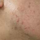 131 | 셀라딕스 131 앰플 후기 턱 여드름 반복되던 피부 변화