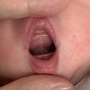 시지연합소아과 | 대구 설소대 시술 후기 // 시지 푸른연합소아과 or 달서구 김신향소아과 선택