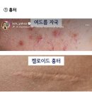 약사가 추천하는 상황 별 피부 연고 이미지