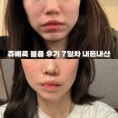 예뻐지는공간.채움 | [공지] 💉 쥬베룩 볼륨 2회 7일차 후기 | 옆볼/앞볼 볼륨으로 중안부 짧아보이는 효과 | 비포/애프터...