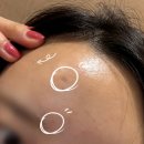 미올한의원 | 의정부 미올한의원 새살침 후기 수두자국 여드름흉터 압출흉터 ★내돈내산★