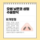 오썸성형외과의원 | 낮은코성형, 수험생 코성형, 대학생 코성형 , 콧대 코끝 성형 오썸성형외과