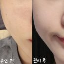 구 연산8동 행정복지센터 | 군산 수송동 퀸다경뷰티 모공디톡스와 물방울 리프팅 받고 브이라인 되찾은 후기
