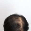 디비전 스칼프 | 평택두피문신 여자 가르마탈모 해결은 디비전스칼프