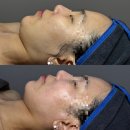 리겐에스테틱 | 전주 신시가지 피부관리 [리겐스킨랩] 플라즈마 관리 후기