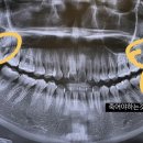 [공지] (1)앞니부분교정후기/내돈내산/광고아님/천안서울수석교정치과후기/천안교정치과