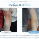 마포삼성약국 | 외음부 가려움 연고 사용법 총정리 (질염vs습진, 비판텐, 스테로이드, 엘리델)