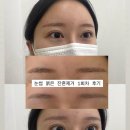 의정부 눈썹 붉은 잔흔제거 • 디어스튜디오 1회차 변화후기
