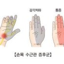 손바닥 통증 원인 치료 증상 방아쇠수지증후군 수근관증후군 말초신경병증 이미지