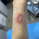 2도 | 심재성 2도 저온화상 치료후기#2 결국 수술!