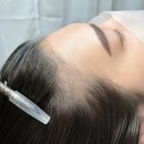 방이동두피 제이앤유뷰티 헤어라인 리터치받은 후기 너무 만족스러워요