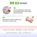 김앤정류마내과의원 | &#39;대전/대구/여수/순천 엄지발가락 마디 통풍 치료는 류마내과에서!&#39; [통풍 병의원]