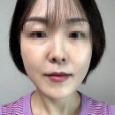 수올 | 나는 솔로 옥순 리프팅｜청담피부과 올타이트 리프팅 400샷 후기