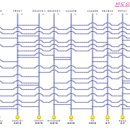 예손헤어라인 이미지