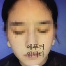 [내 돈솔직후기 ] 남악피부과 토닝 후기 비포에프터있어요