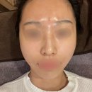 압구정 온다리프팅 대신 튠페이스 튠라이너 2회차 후기 가격 통증 효과 유지기간