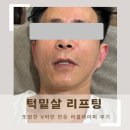 턱밑살 리프팅 또렷한 V라인 만든 리셀테라피 후기